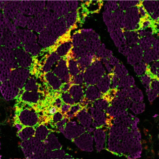 10th Annual UC Irvine Neuromuscular Pathology Colloquium Banner
